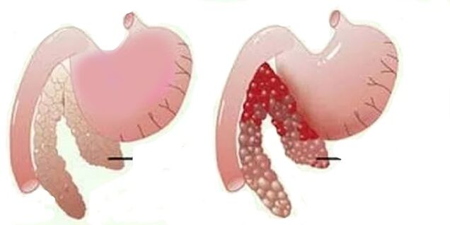 胰腺炎